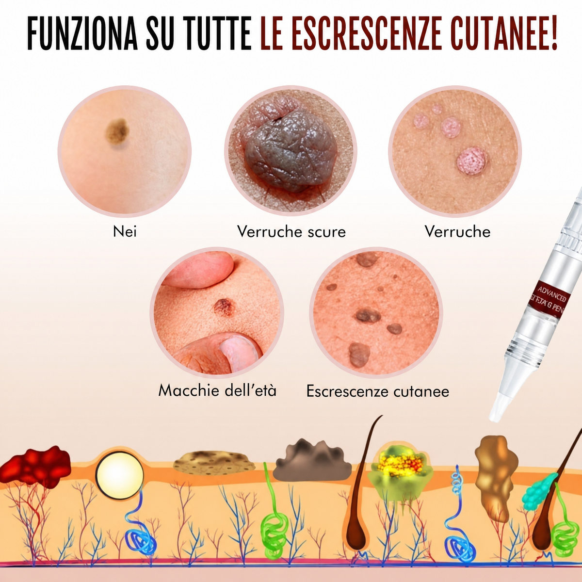 Penna naturale per la rimozione di fibromi cutanei e nei